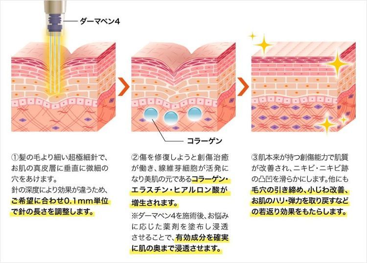 No. 6 - TCB東京中央美容外科 ダーマペン - 4